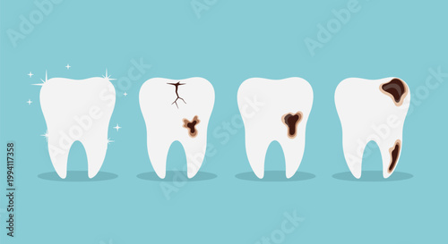 Tooth decay stages vector illustration showing healthy tooth plaque cavity damage progression dental care and oral hygiene concept