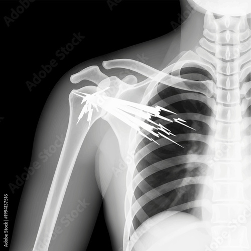 Medical X-ray radiograph of the right shoulder and upper chest cavity showing the humerus, clavicle, and ribs with a sharp metallic foreign object causing starburst artifacts.