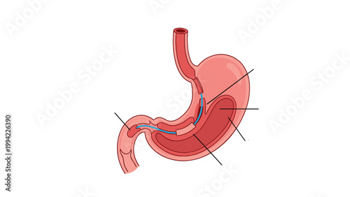 Diagram shows a human stomach with internal tubes, illustrating a medical procedure such as gastric bypass or a similar digestive tract intervention.