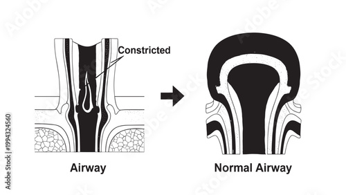 Comparison of Constricted and Normal Airway Structures in Medical Illustration.