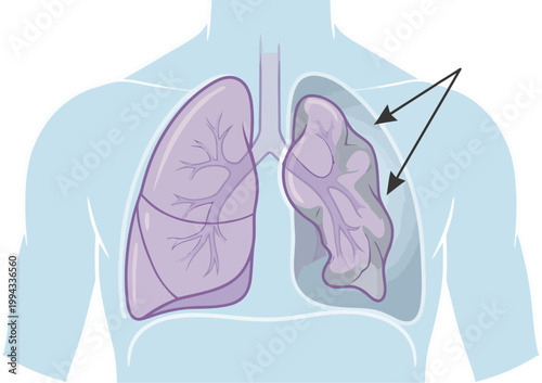 Anatomical Illustration of Human Lungs Showing Internal Damage and Disease