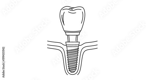 Dental implant screw illustration for oral healthcare and medical education