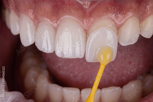 Close-up of a porcelain dental veneer being applied to a tooth with a dental tool for a cosmetic dentistry smile makeover