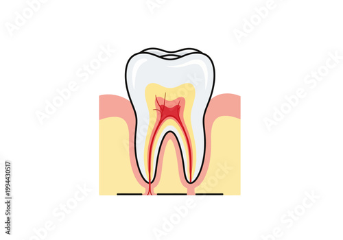 A detailed illustration of a tooth with a visible pulp chamber and roots in a gum.