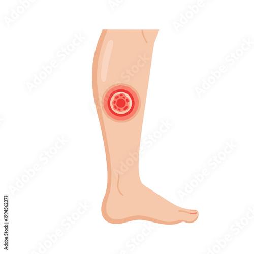 Human Leg Showing Skin Rash and Inflammation