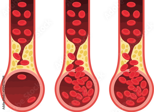 Blood vessels illustration normal artery vs blocked artery with cholesterol plaque medical comparison diagram clean vector isolated