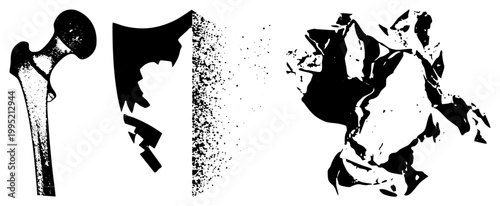Anatomical femur break, shattered skeletal pieces, halftone bone damage graphics, medical illustration, trauma visual, forensic cutout.