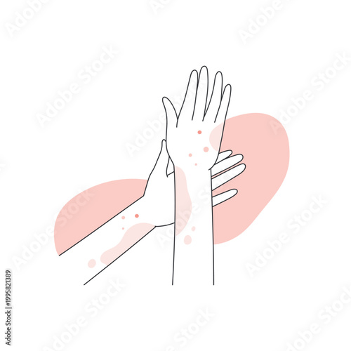 Human hands covered with red rash. Allergic reaction on hands, atopic dermatitis line vector illustration
