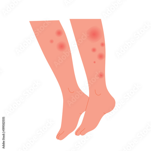 Human legs covered with red rash. Feet with allergic reaction, skin irritation flat vector illustration
