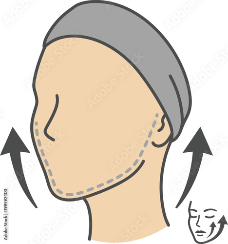 Facelift illustration: An illustration shows the transformative effects of a facelift, showcasing the upward lift and tightening of the skin for a more youthful appearance.