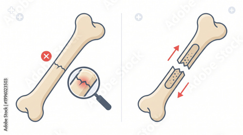 Bone Fracture vs Internal Fixation Surgery – Orthopedic Medical Procedure for Broken Bone Repair