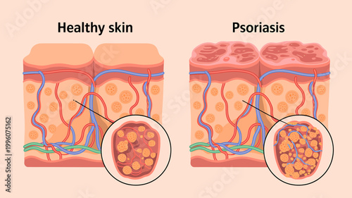 Healthy skin and psoriasis comparison anatomy skin layers crosssection