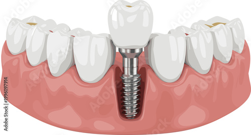 Dental Implant Illustration with Tooth Restoration in a Human Jaw for Medical, Healthcare, and Dentistry Design Projects
