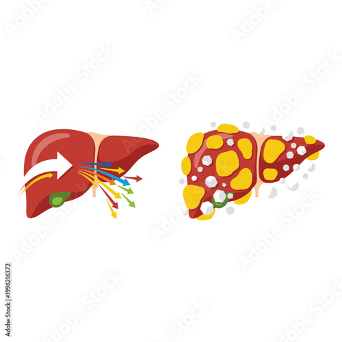 Liver anatomy, healthy and diseased liver, illustration, medical vector, organ comparison
