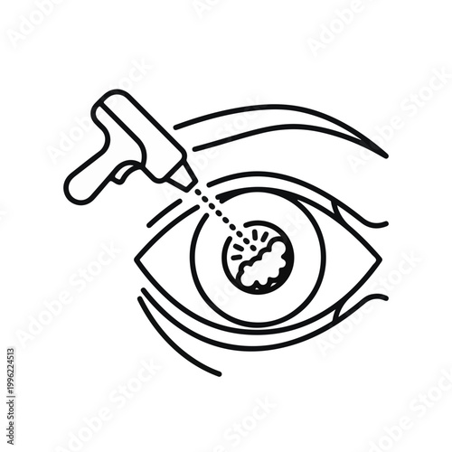 Laser eye surgery illustration. The image showcases the procedure, highlighting the eye, the laser tool and its beam