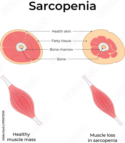 Sarcopenia Medical Illustration Showing Muscle Loss and Bone Health Comparison Design Vector