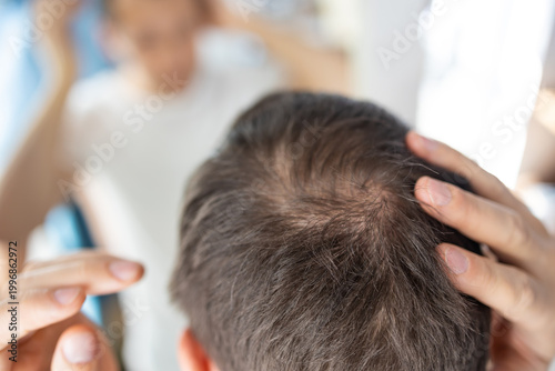 Tableau sur toile Top View of a Man’s Head Showing Early Stages of Hair Loss or Thinning Hair at t