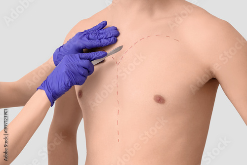 Tableau sur toile Plastic surgeon with scalpel and markings on man's chest against light backgroun
