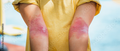 Close-up of a child's arms showing red, inflamed, dry skin in the inner elbows, indicating atopic dermatitis or eczema. Useful for medical and health education materials.
