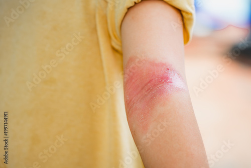 Close-up of child's arm showing red, inflamed, and dry skin in the antecubital fossa. This condition is commonly associated with atopic dermatitis, characterized by redness, irritation, inflammation.