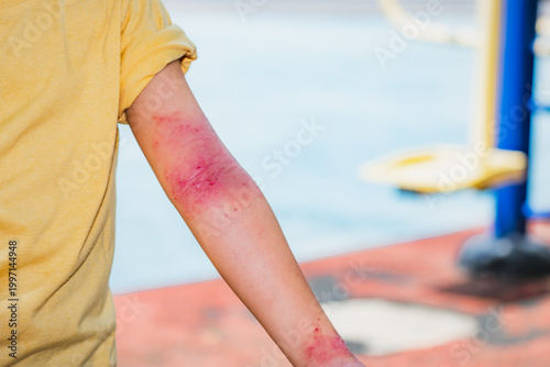 Close-up of a child's arm with severe skin rash, inflamed and red in the inner elbow and wrist, indicating atopic dermatitis (eczema) flare-up. Useful for medical and health context.