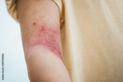 Canvas Print Close-up of a child's inner elbow with severe red, scaly skin rash, indicating atopic dermatitis or eczema
