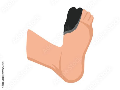 Diabetic Foot Gangrene Ulcers Illustration
