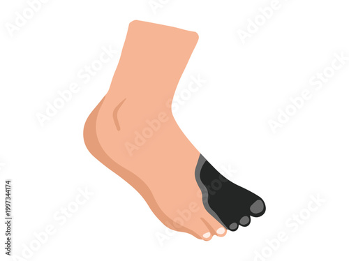 Hand Drawn Diabetic Foot Gangrene Ulcers
