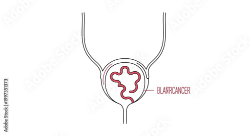 Conceptual illustration of bladder cancer featuring a red, tumor-like growth within the organ, visualized with continuous line art and medical text