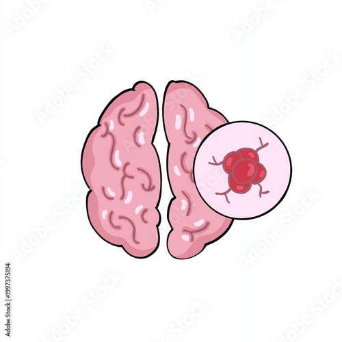 Brains with tumor simple flat illustration for healthcare educational 