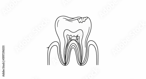 Anatomical diagram of a tooth with visible decay on the crown and internal structure