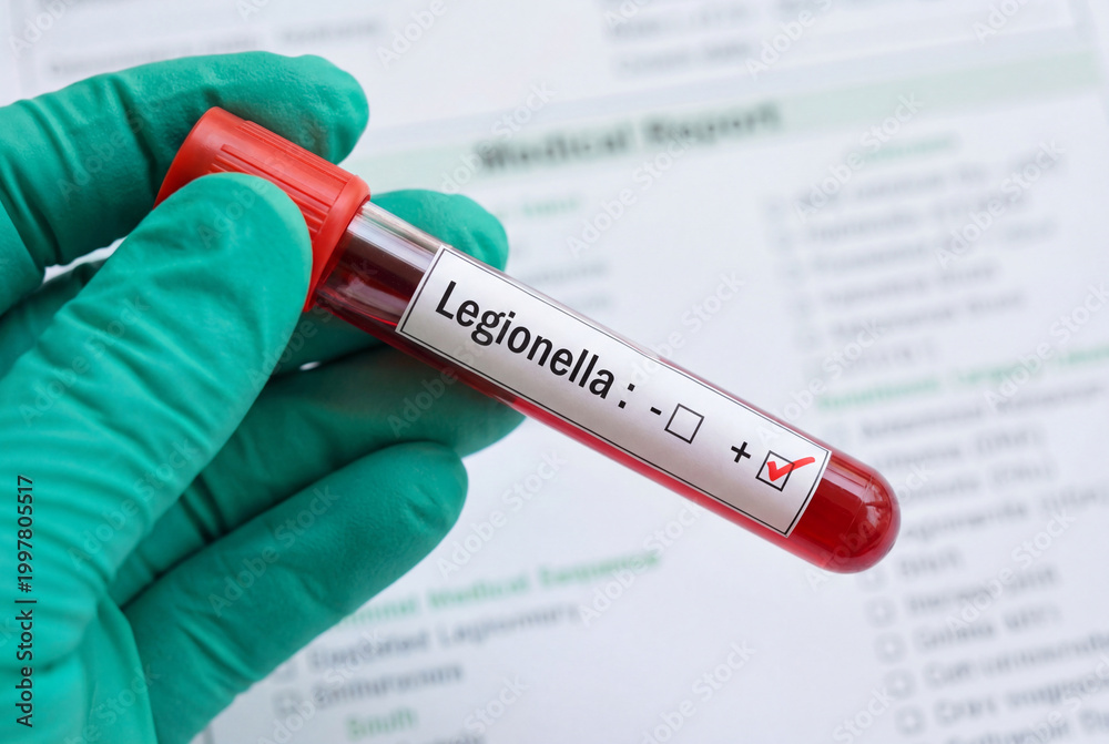 Obraz premium Hand holding positive legionella blood test tube sample