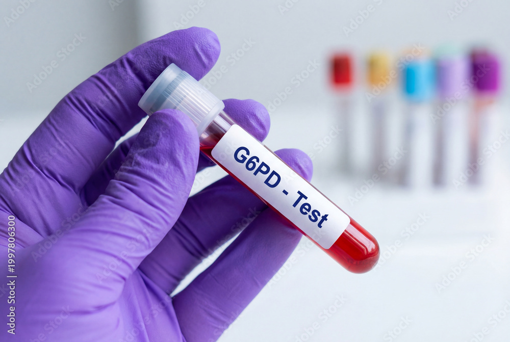 Fototapeta premium Hand in purple glove holding blood sample tube labeled g6pd test in lab