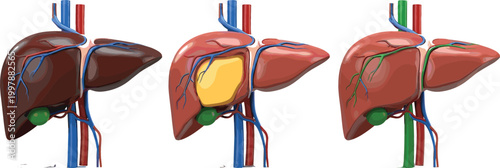 Human liver anatomy vector illustration set showing healthy liver fatty liver disease and medical internal organ structure with veins arteries and gallbladder
