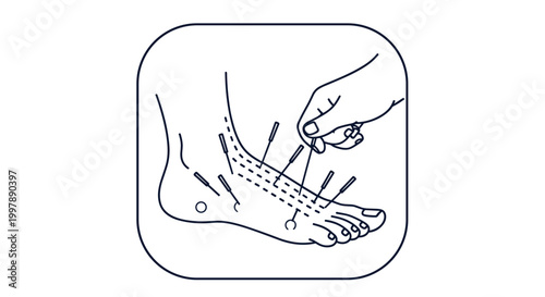 Close up of a human foot undergoing traditional Chinese acupuncture treatment with many needles inserted into specific pressure points for healing.