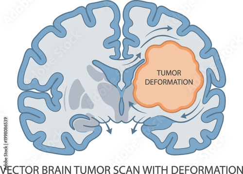 Vector brain tumor scan with deformation showing internal growth