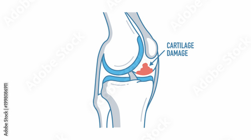 Knee joint injury and cartilage damage illustration