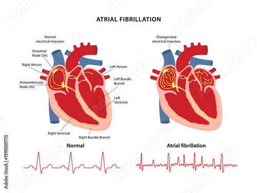 Atrial fibrillation. Comparison of electrocardiograms of normal heartbeat and those of atrial fibrillation. Vector illustration in flat style isolated on white background.