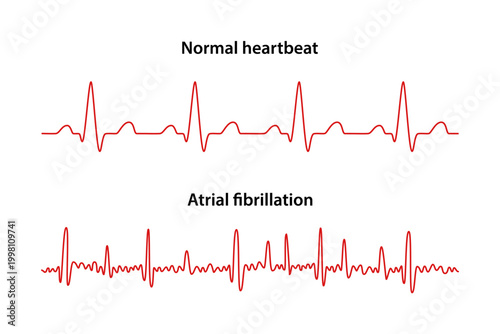 Atrial fibrillation. Comparison of electrocardiograms of a normal heartbeat and those of atrial fibrillation. Heart cardiogram. Vector illustration in flat style isolated on white background