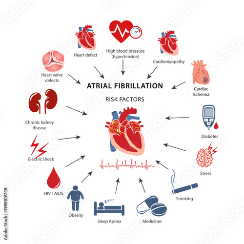 Diagram of risk factors for atrial fibrillation in humans. Flat style vector illustration isolated on a white background.