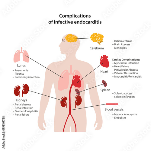 Complications of infective endocarditis. An image of the human body with key affected organs labeled. Flat style vector illustration isolated on a white background.