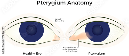 Pterygium Anatomy Medical Illustration