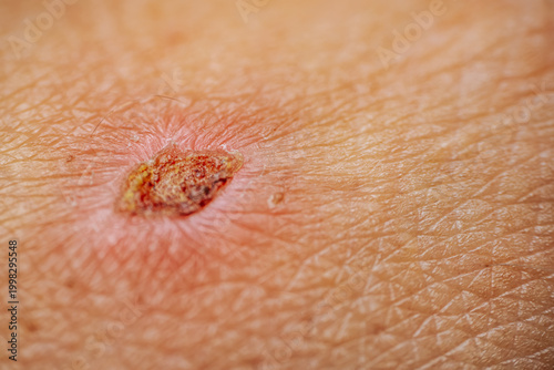 Photography Close-up view of a healing wound on human skin showing redness and scab formatio