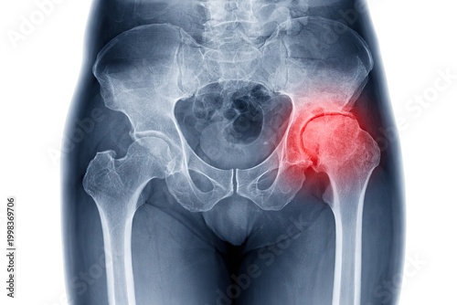 X-ray of human hip joint with inflammation highlighted in red isolated on white background
