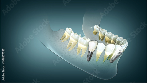 Φωτογραφία Dental implant with lower jawbone aligning beautifully with healthy teeth