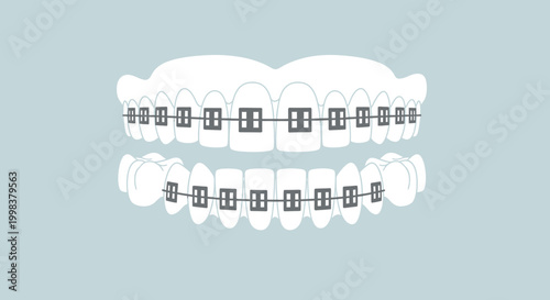 Healthy human teeth with dental braces for orthodontic treatment on a pale blue background