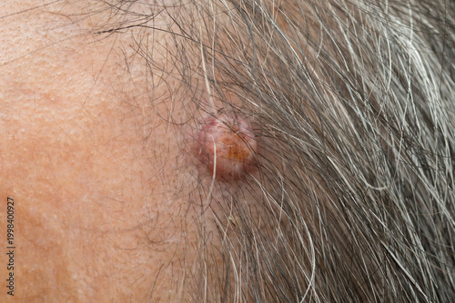 Photos Close-up of scalp cyst (sebaceous cyst), small lump on human scalp caused by blo