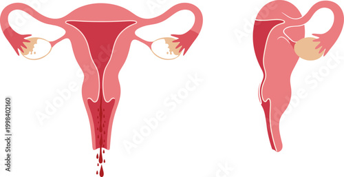 Female Reproductive System Flat Design Illustration Showing Uterus with Menstruation and Ovarian Cyst for Women Health and Medical Education Vector Illustration