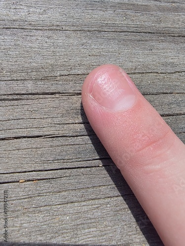 Foto Nail pitting