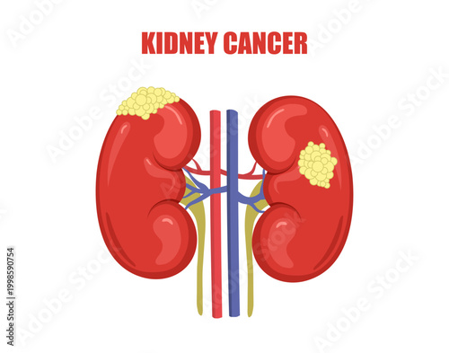 Renal disease and kidney cancer treatment. Medical care or chemotherapy concept. Anatomy diagram and health icon. Vector cartoon illustration.